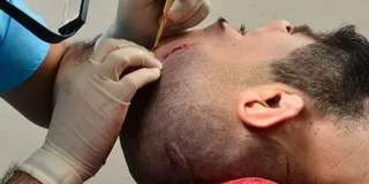 DHI Hair Transplant in Islamabad – A Reliable Hair Restoration Option at Enfield Royal Clinic Islamabad