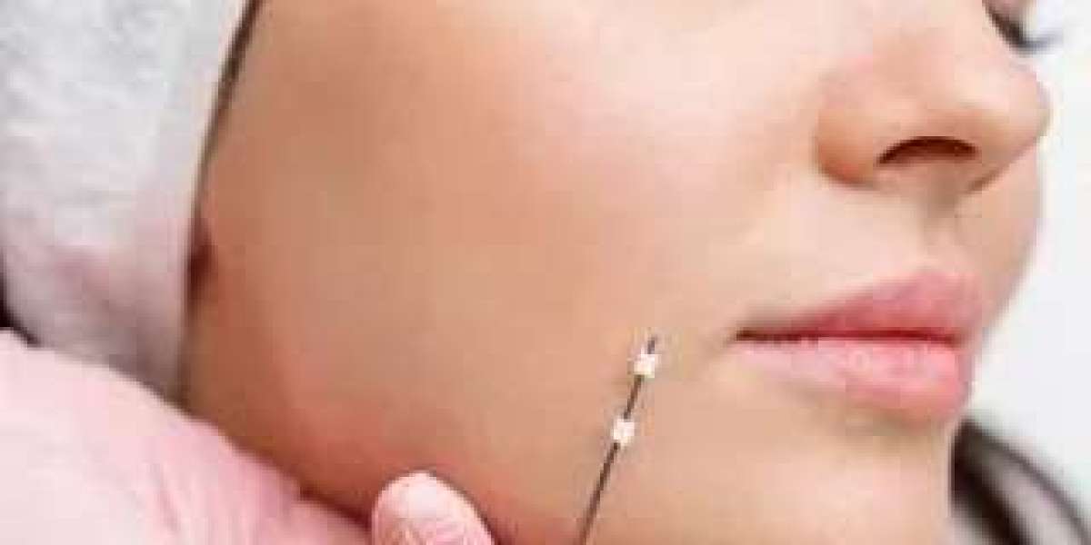Everything You Need to Know About Thread Lift Treatments in Islamabad
