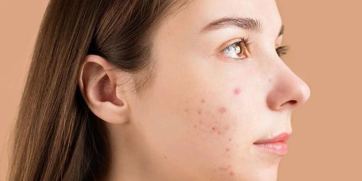 Is early Acne Treatment better?