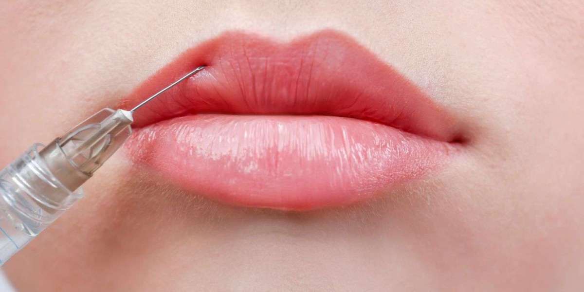 Russian Lip Filler Recovery Timeline Explained