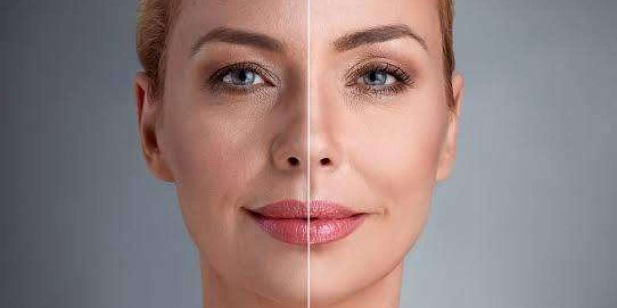 What Is the Recovery Time After Endolift Surgery?