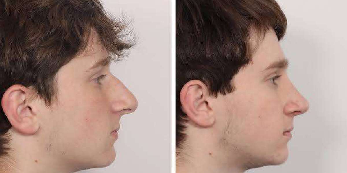 Who Is an Ideal Candidate for Male Rhinoplasty?