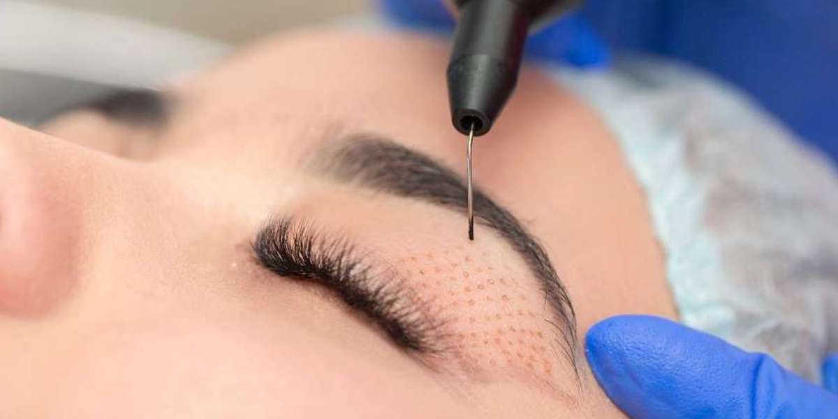 Can Plasma Pen Treat Acne Scars?