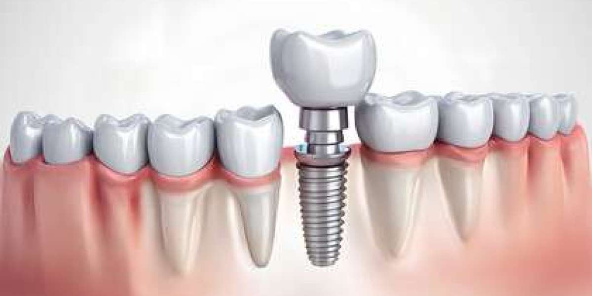 How Modern Dental Implants Brisbane Restore Function and Natural Beauty