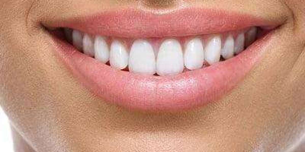 Is Getting a Hollywood Smile Painful?