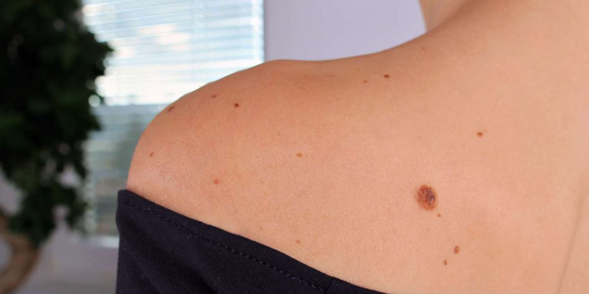 What is Moles Removal used for?