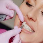 Cost of Teeth Veneers