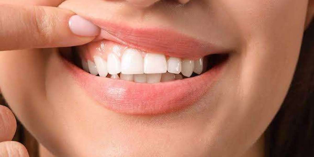 Effective Solutions for Gum Recession in Islamabad