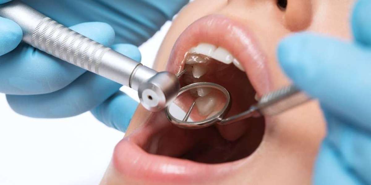 Restore Worn Teeth with Composite Fillings