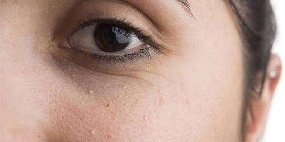 What are the biggest benefits of Milia Treatment?
