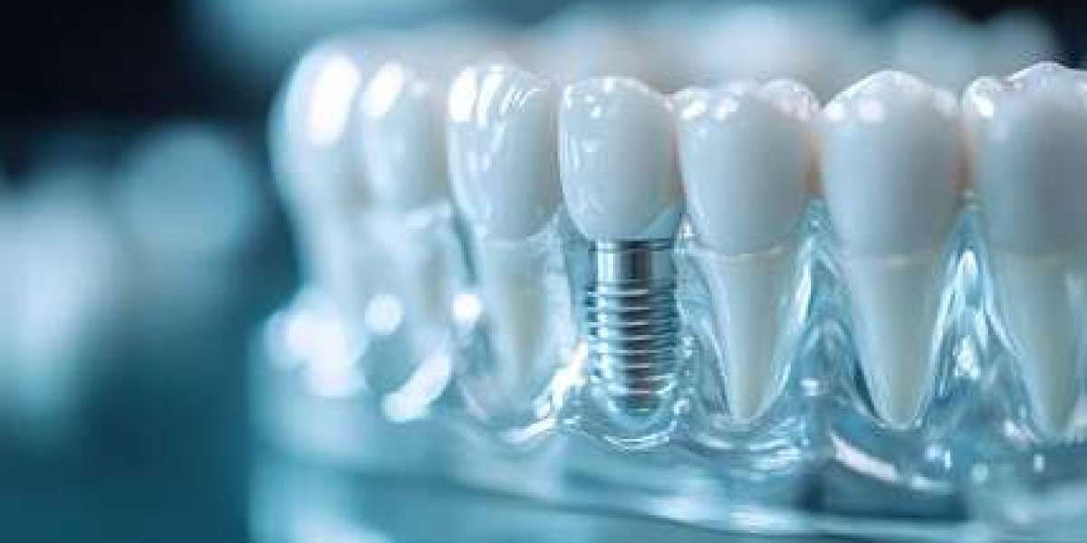 How to Care for Your All-On-4 Dental Implants Brisbane for Lasting Results