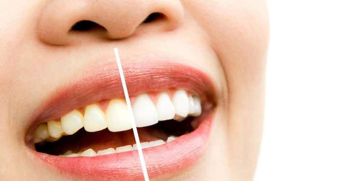 How Teeth Whitening Camarillo CA Can Boost Your Confidence and Smile