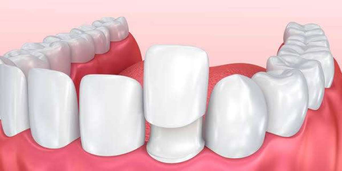 Create a Stunning Smile with Non-Prep Veneers at Glam Aesthetic Clinic