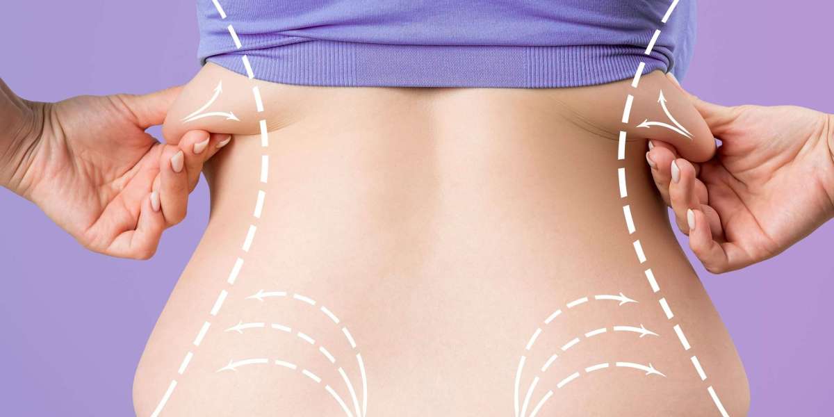 Advanced Sculpting Techniques for a Beautiful Figure at Glam Clinic Islamabad