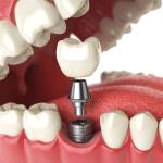 Costs of Dental Implants