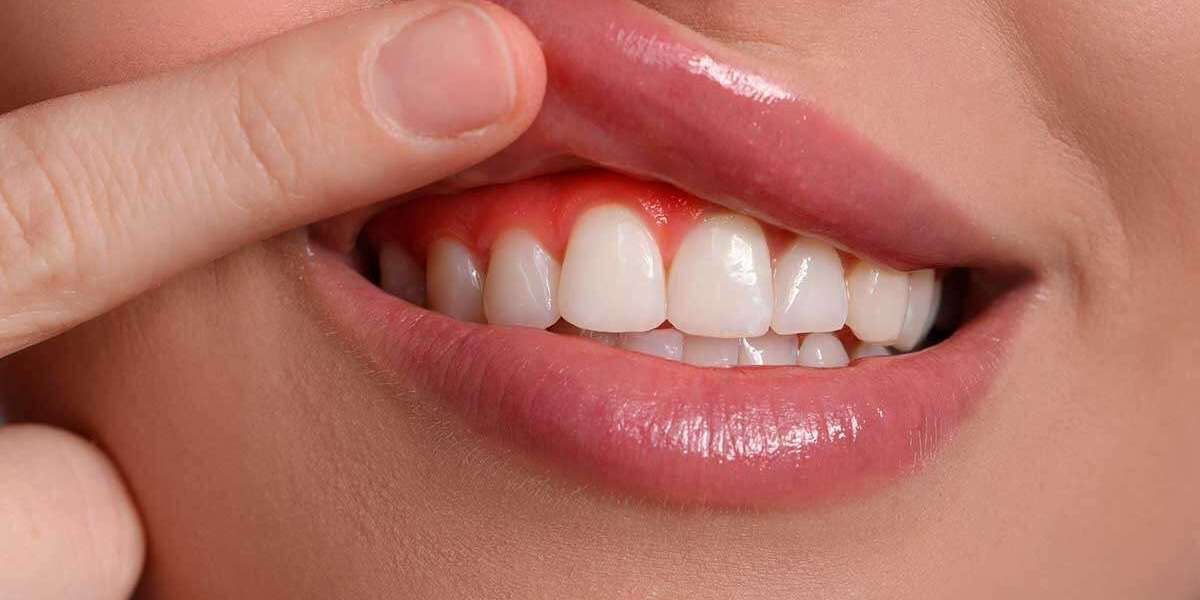 Receding Gums: Causes, Symptoms, and Treatment