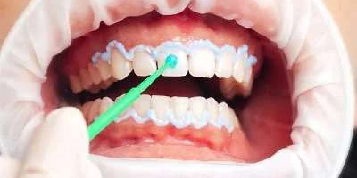Hydrogen Peroxide Teeth Whitening for Stain-Free Teeth