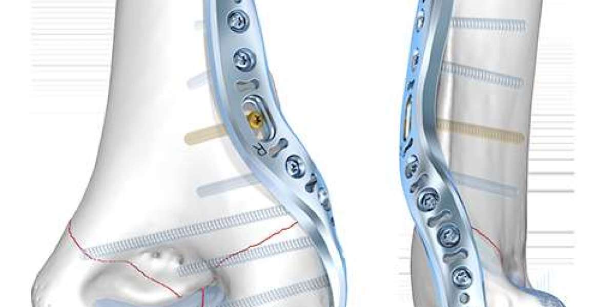 Bone Fixation Plates Market Summary: Key Insights into Orthopedic Implant Advancements