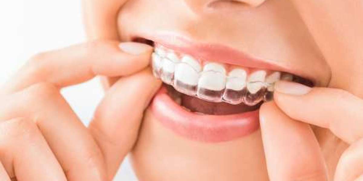 Invisalign Brisbane: What Happens at Your First Consultation?