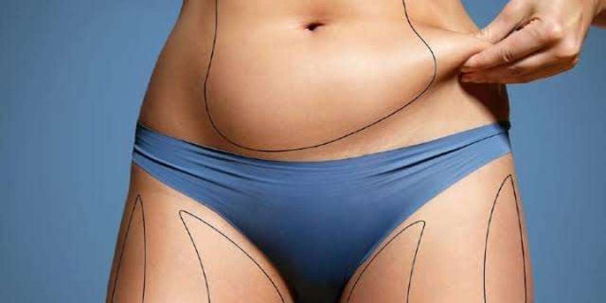 Does SculpSure Body Contouring require surgery?