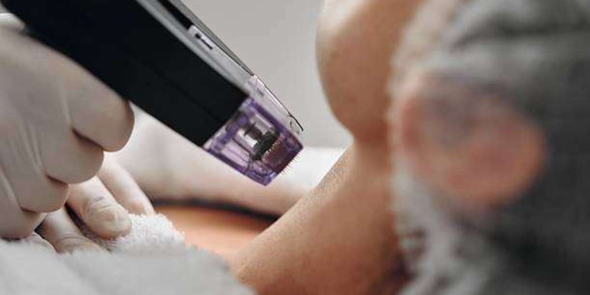 Morpheus8 Microneedling in Cape Coral, FL: Your Complete Guide to Preparation, Recovery, and Results