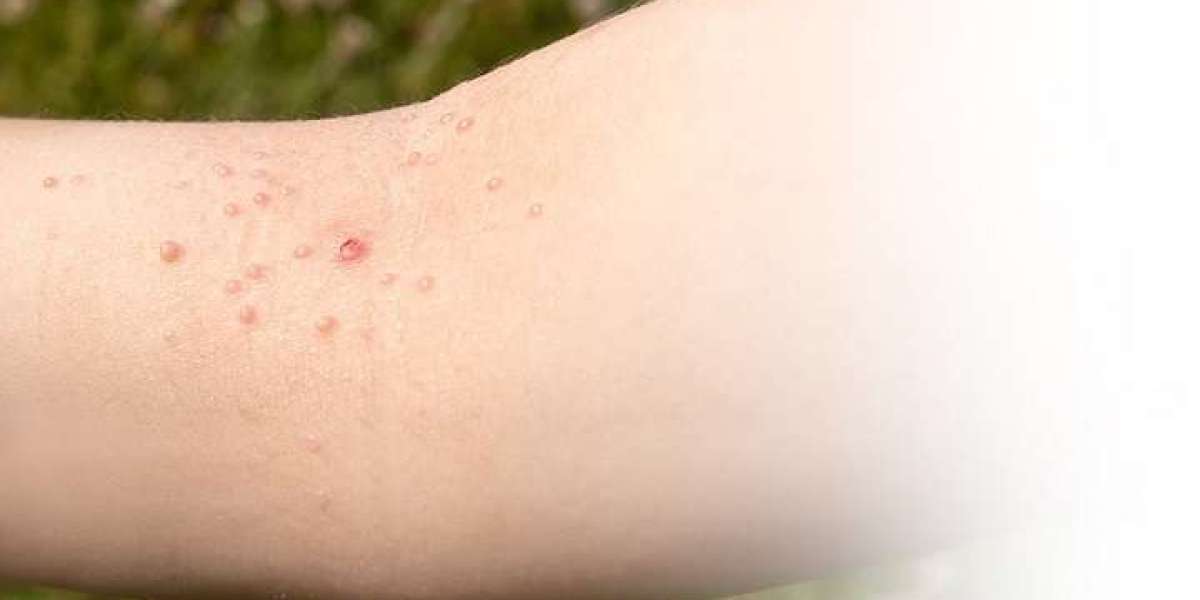 How long do warts usually last?