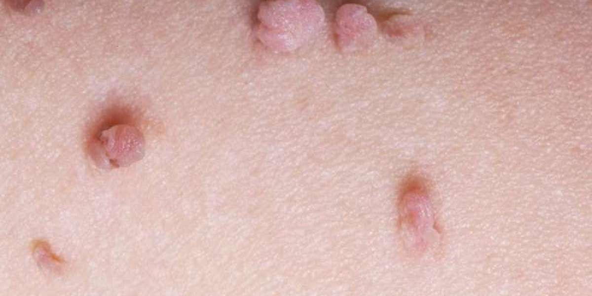 Why do skin tags develop?