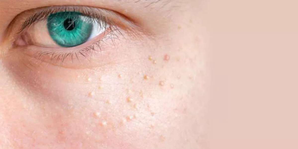 Are Milia Treatment results natural-looking?