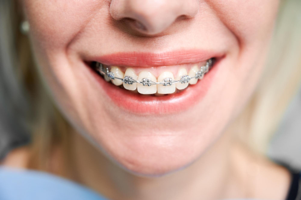 How Long Do Braces Really Take to Straighten Teeth?