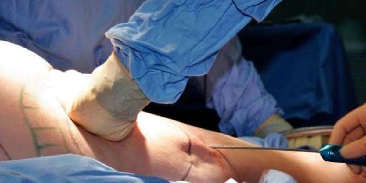 How Long Does Swelling Last After Liposuction in Islamabad?
