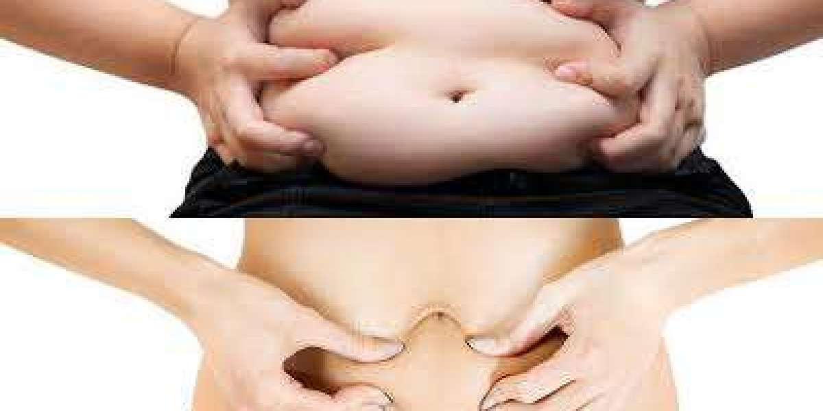 Can Fat Transfer Treatment in Islamabad Be Done Under Local Anaesthesia?