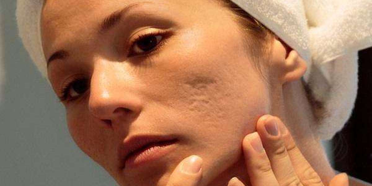 Can Facial Scar Revision in Islamabad Be Combined With Other Scar Treatments?