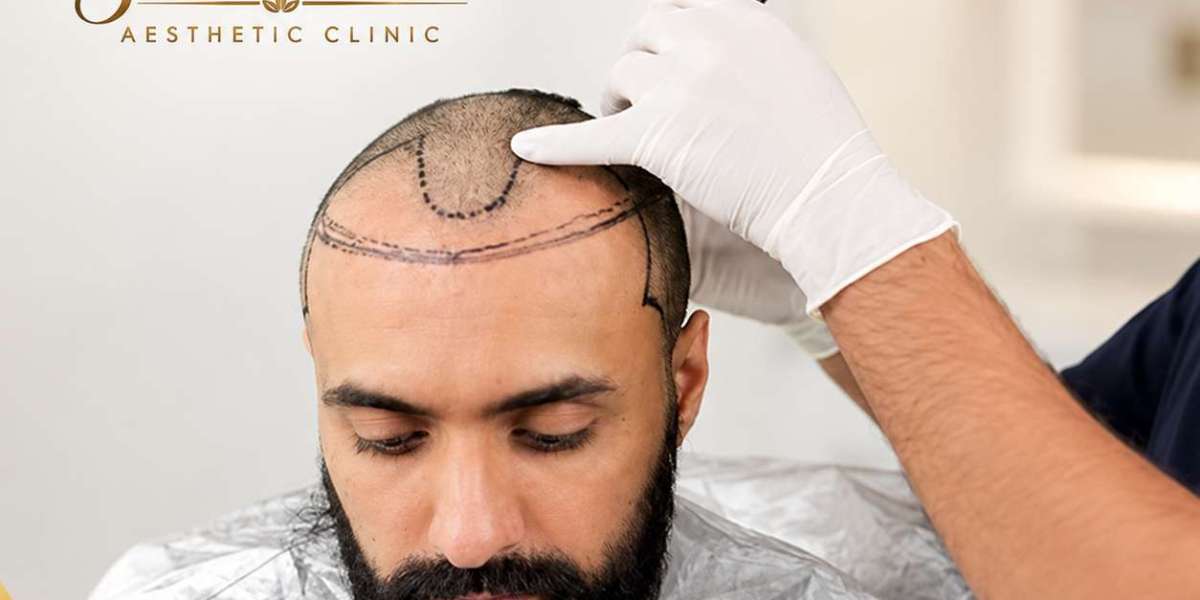 Can a Hair Transplant Leave Scars?