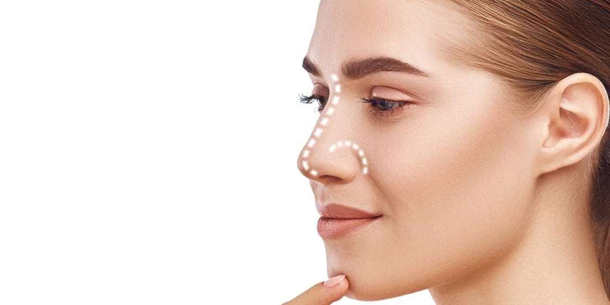 How Do Cartilage Grafts Work in Rhinoplasty in Islamabad?
